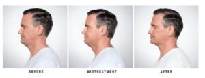 Chin fat before and after