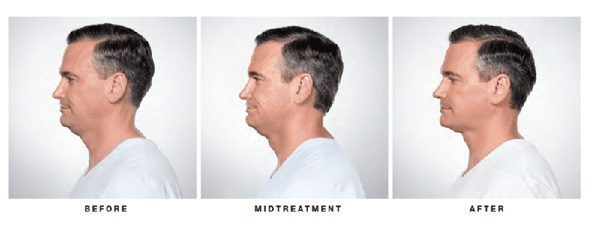 Chin fat before and after