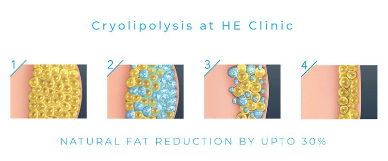 Cryolipolysis