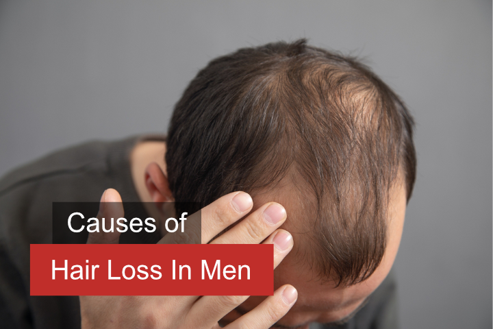 hair loss in men